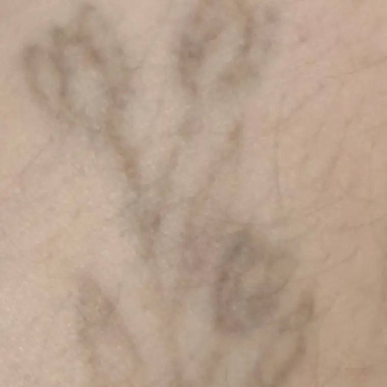Depois: tatuagem de tulipas em traço fino quase apagada
