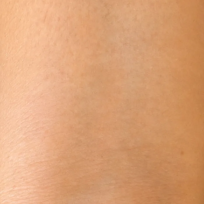 Depois: o pulso sem a tatuagem de trevo, totalmente removida